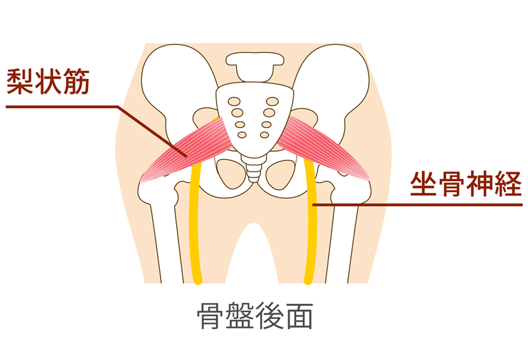 坐骨神経痛