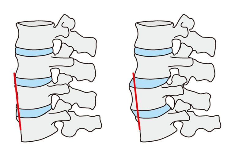 腰椎すべり症とは