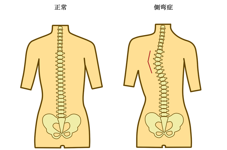 側弯症とは