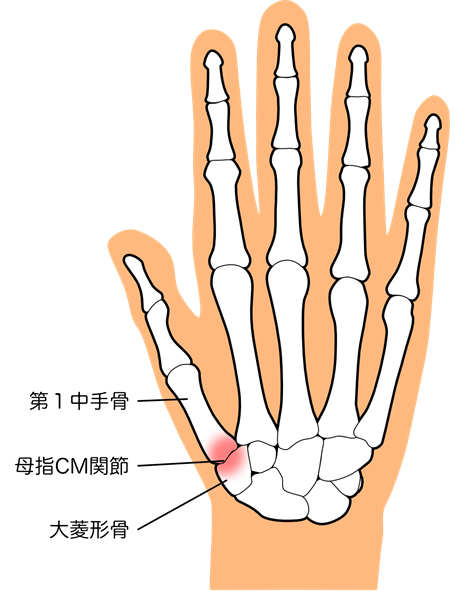 母指CM関節症