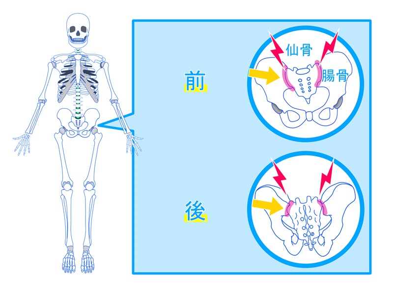 仙腸関節炎とは