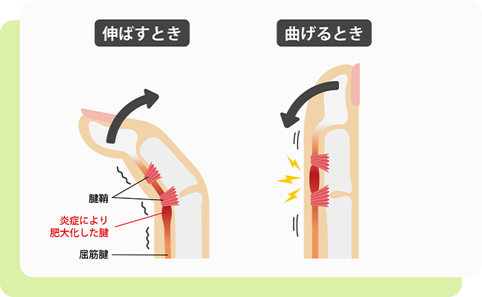 そもそもばね指とは