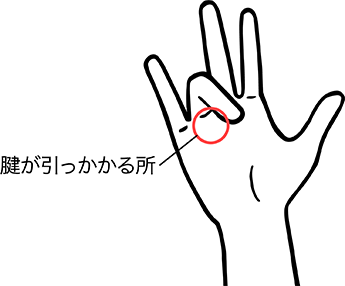 エコーガイド下経皮的腱鞘切開術とは？