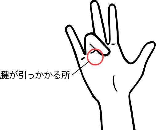 エコーガイド下経皮的腱鞘切開術とは？